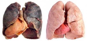 polmoni del fumatore e sani