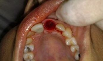 il posto del dente estratto